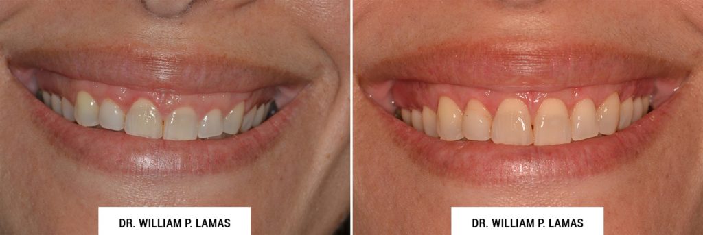 Crown Lengthening Before & After Photo - William P. Lamas, DMD - Periodontics & Dental Implants. Address: 2645 SW 37th Ave Suite 304, Miami, FL 33133 Phone: (305) 440-4114