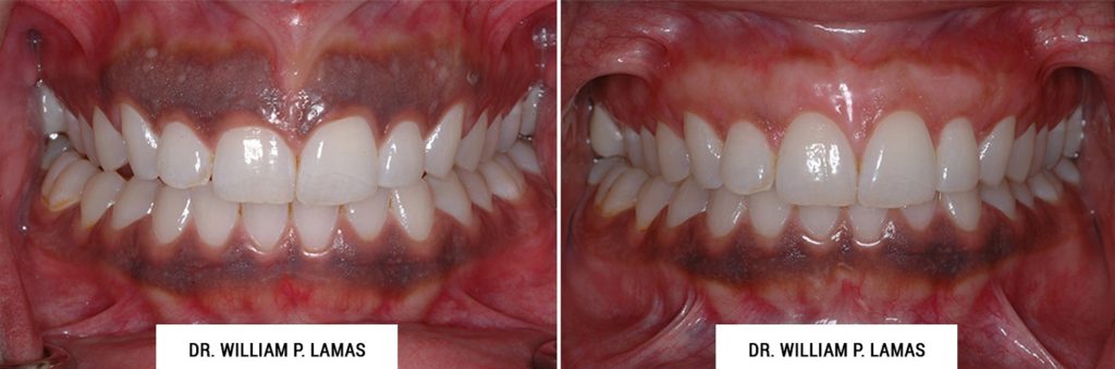 Dark Gum Depigmentation Before & After Photo - William P. Lamas, DMD - Periodontics & Dental Implants. Address: 2645 SW 37th Ave Suite 304, Miami, FL 33133 Phone: (305) 440-4114