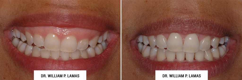 Gummy Smile Correction Before & After Photo - William P. Lamas, DMD - Periodontics & Dental Implants. Address: 2645 SW 37th Ave Suite 304, Miami, FL 33133 Phone: (305) 440-4114