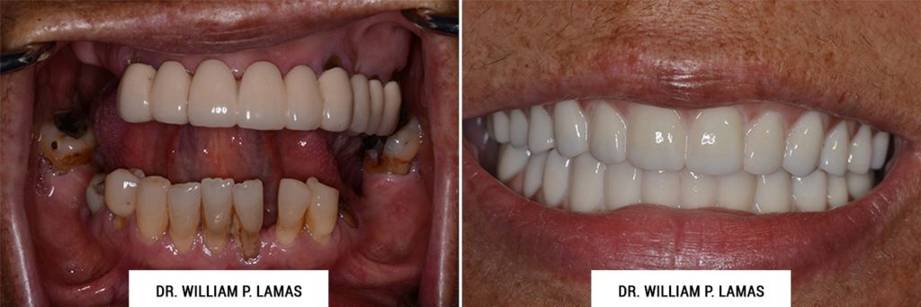 TeethXPress Dental Implants Before & After Photo - William P. Lamas, DMD - Periodontics & Dental Implants. Address: 2645 SW 37th Ave Suite 304, Miami, FL 33133 Phone: (305) 440-4114