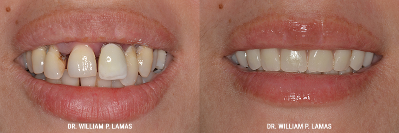All-on-4 Dental Implants Before & After Photo - William P. Lamas, DMD - Periodontics & Dental Implants. 