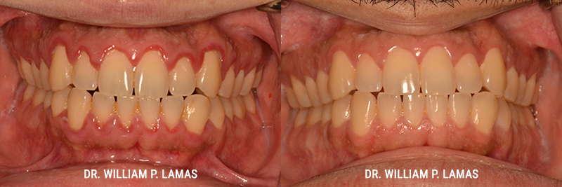 Dental Teeth Cleaning Before & After Photo - William P. Lamas, DMD - Periodontics & Dental Implants. 