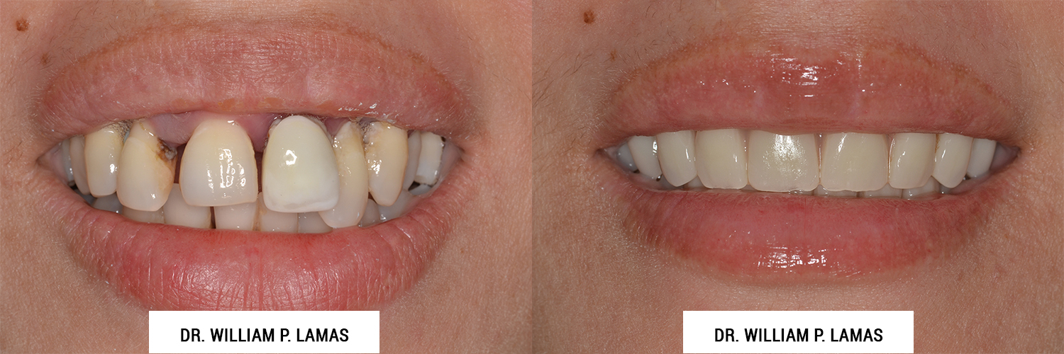 All-on-4 Dental Implants Before & After Photo - William P. Lamas, DMD - Periodontics & Dental Implants. 