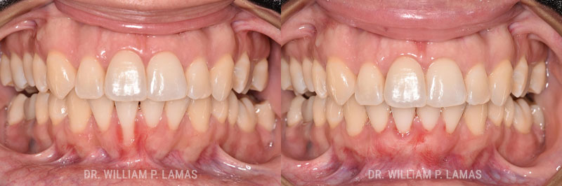 Gum Grafting Treatment Before & After Photo - William P. Lamas, DMD - Periodontics & Dental Implants