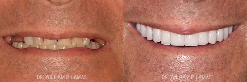 Dental Implants Repair Before & After Photo - William P. Lamas, DMD - Periodontics & Dental Implants. 