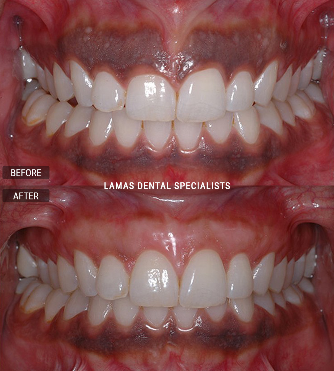 Dark Gum Depigmentation Before & After Photo