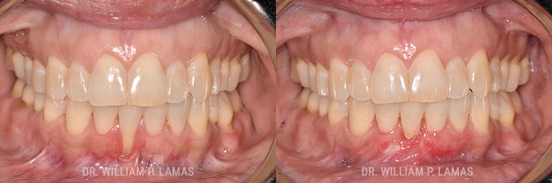 Gum Grafting Treatment Before & After Photo - William P. Lamas, DMD - Periodontics & Dental Implants