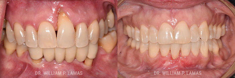 Gum Grafting Treatment Before & After Photo - William P. Lamas, DMD - Periodontics & Dental Implants